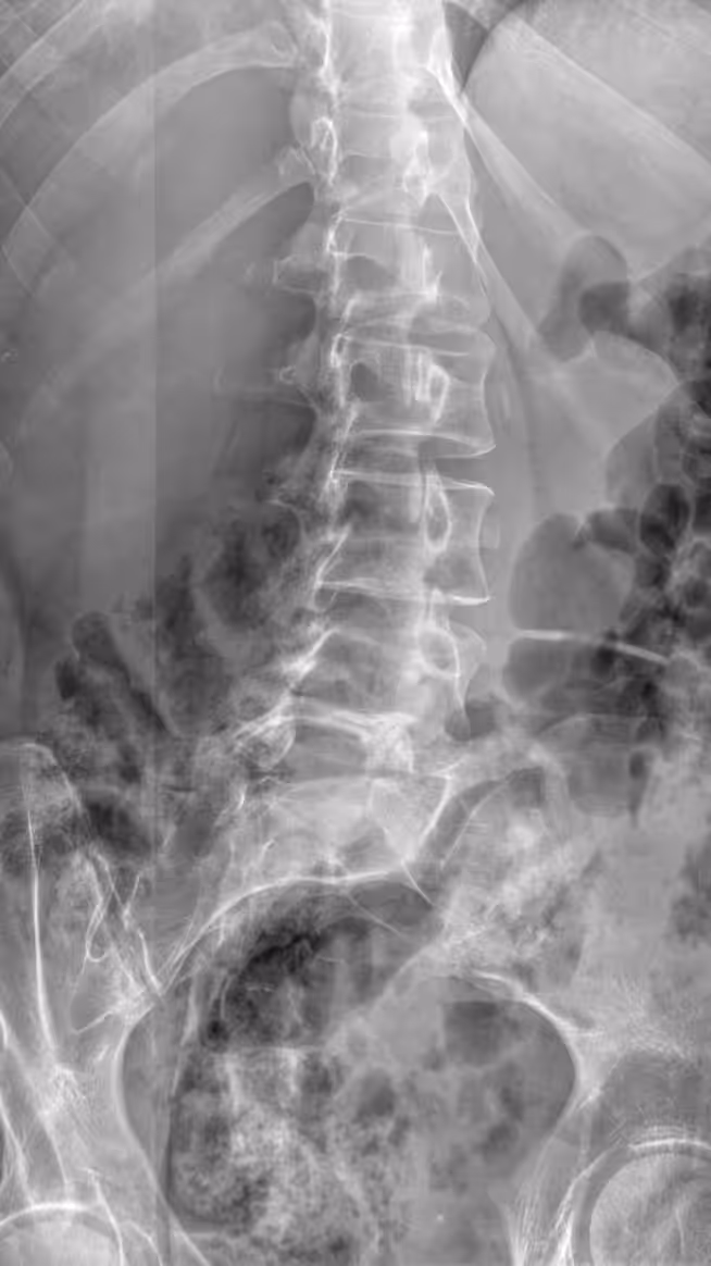 X-RAY: I, II, III
