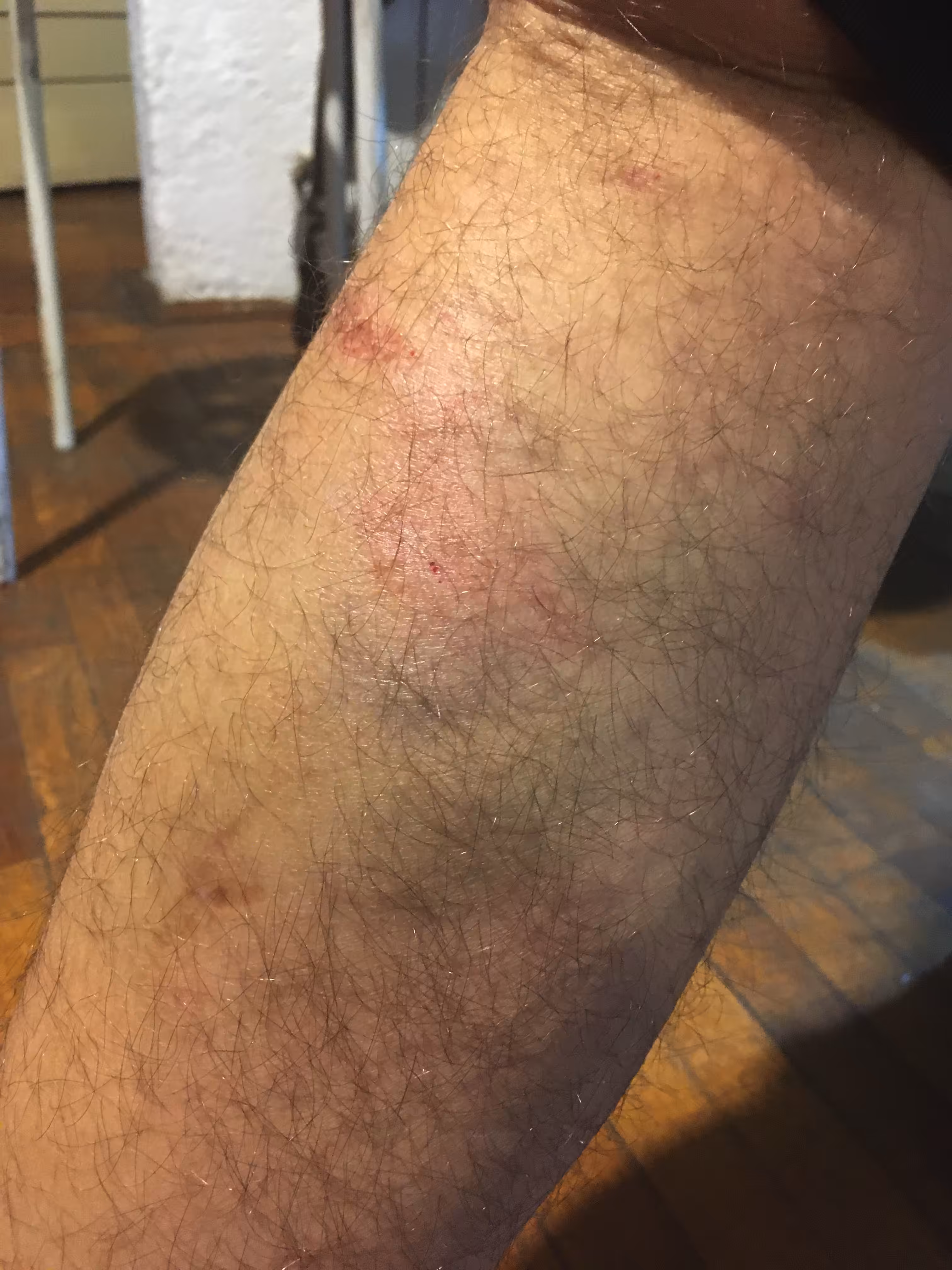 bruise #2