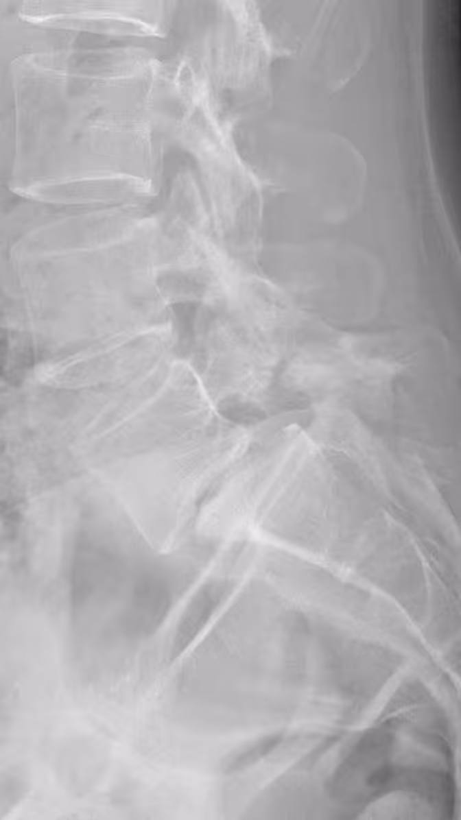 X-RAY: IV