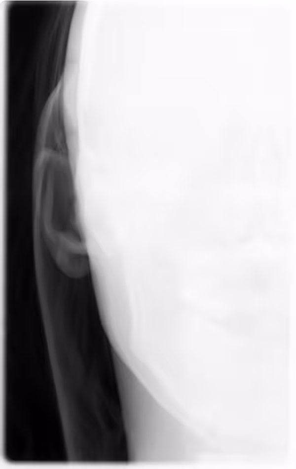 Blinking (Dental CT)
