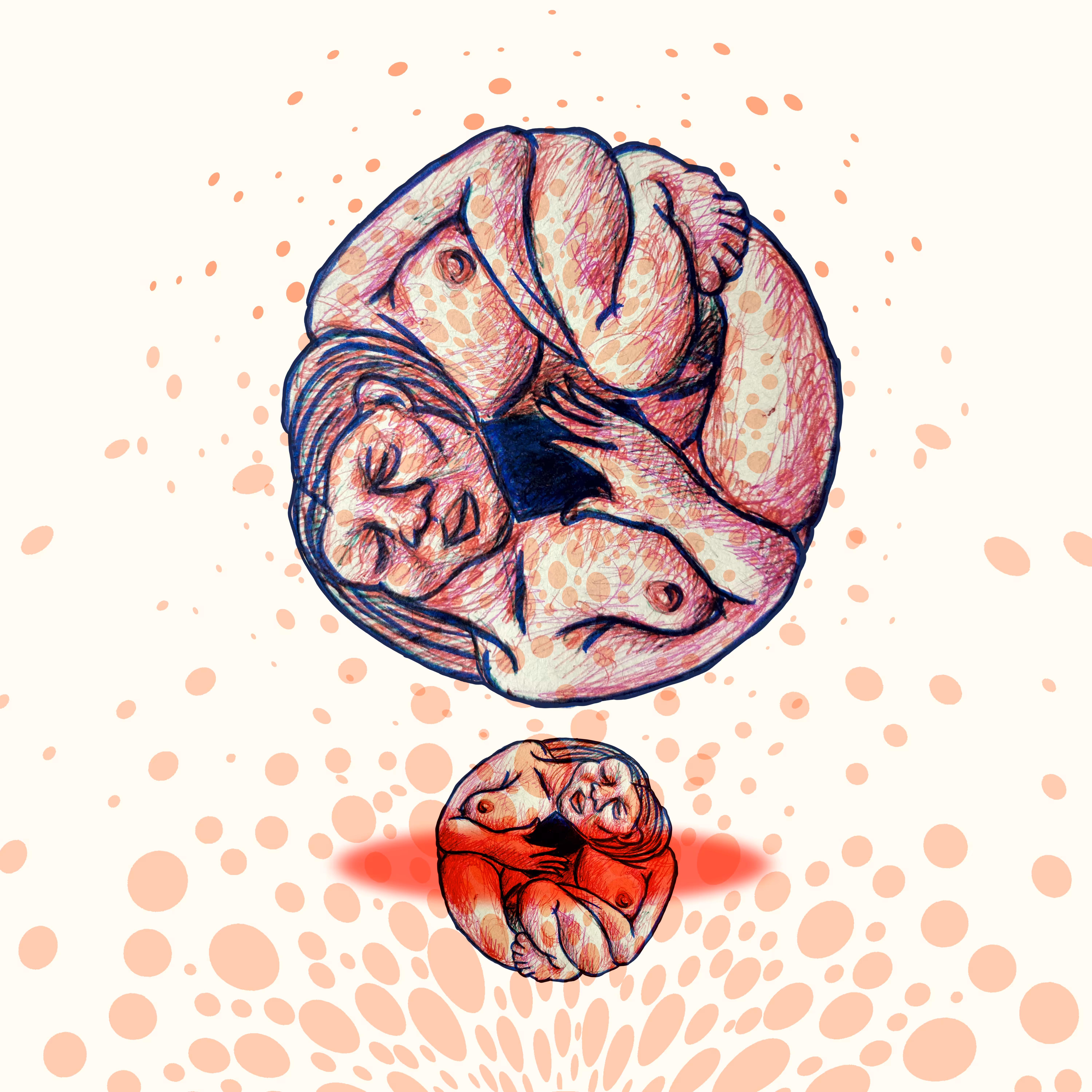 sphered attachment, spherical detachment