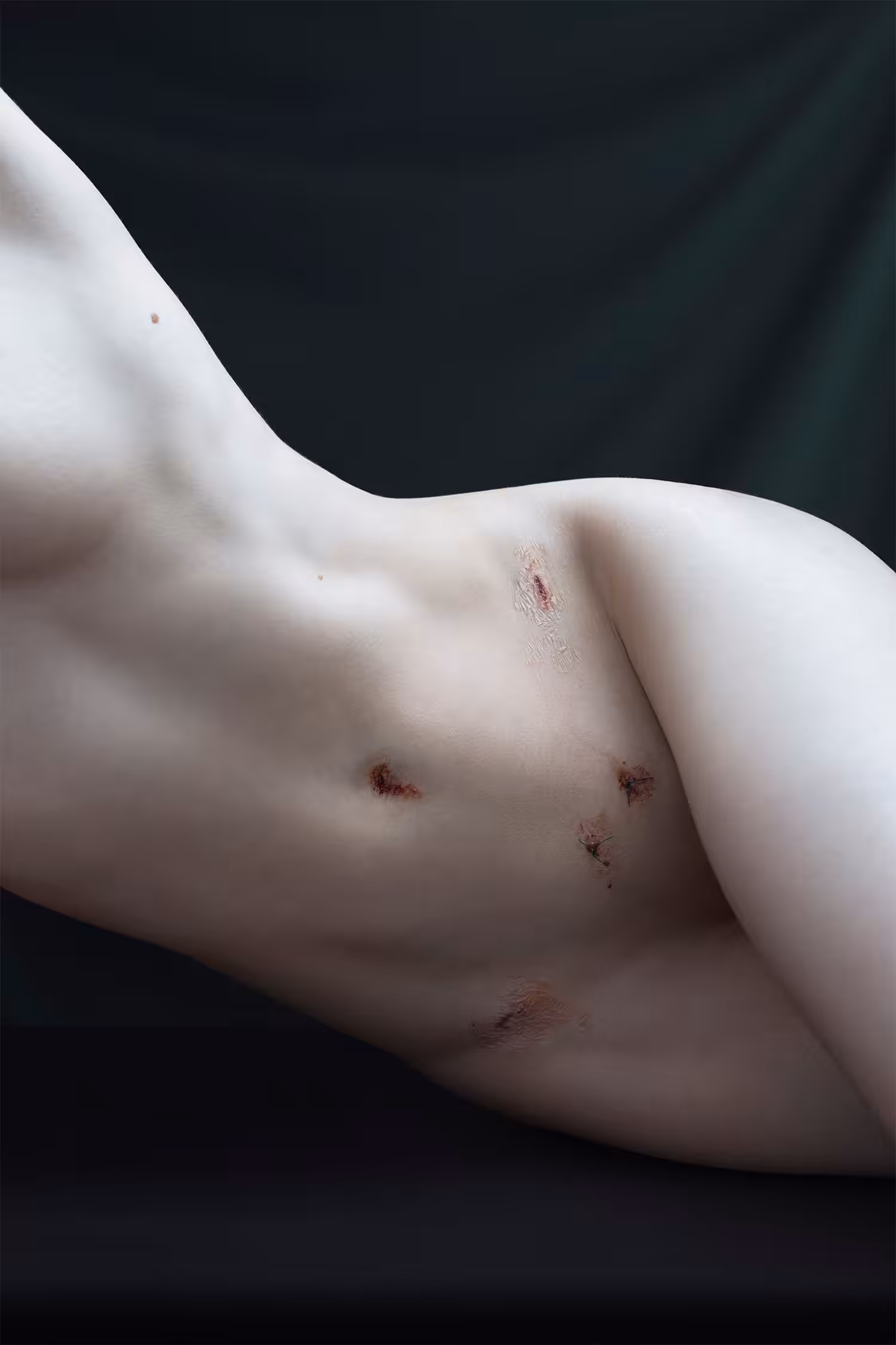 Endometriosis: A Study of Pain