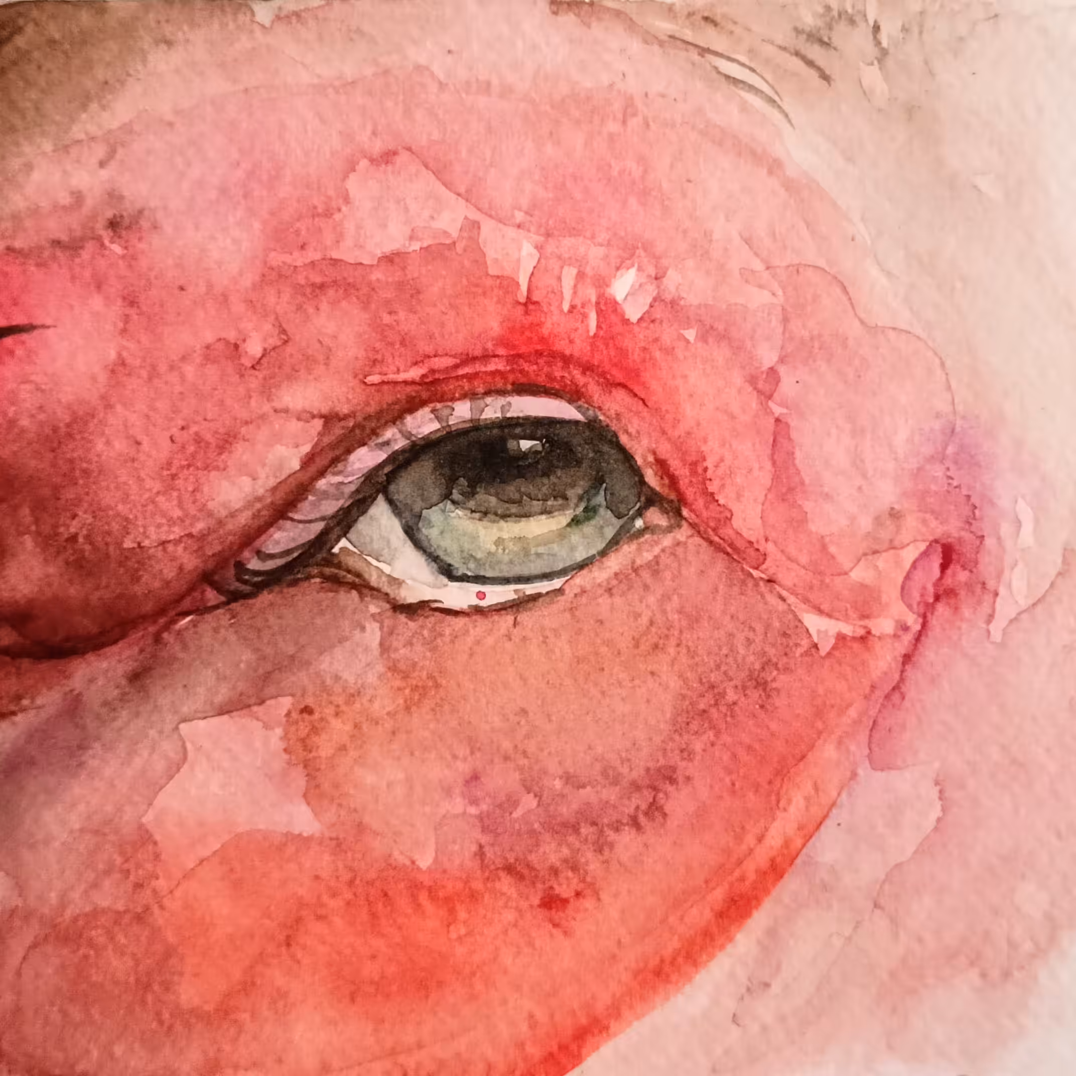 Allergic Reaction On Eye
