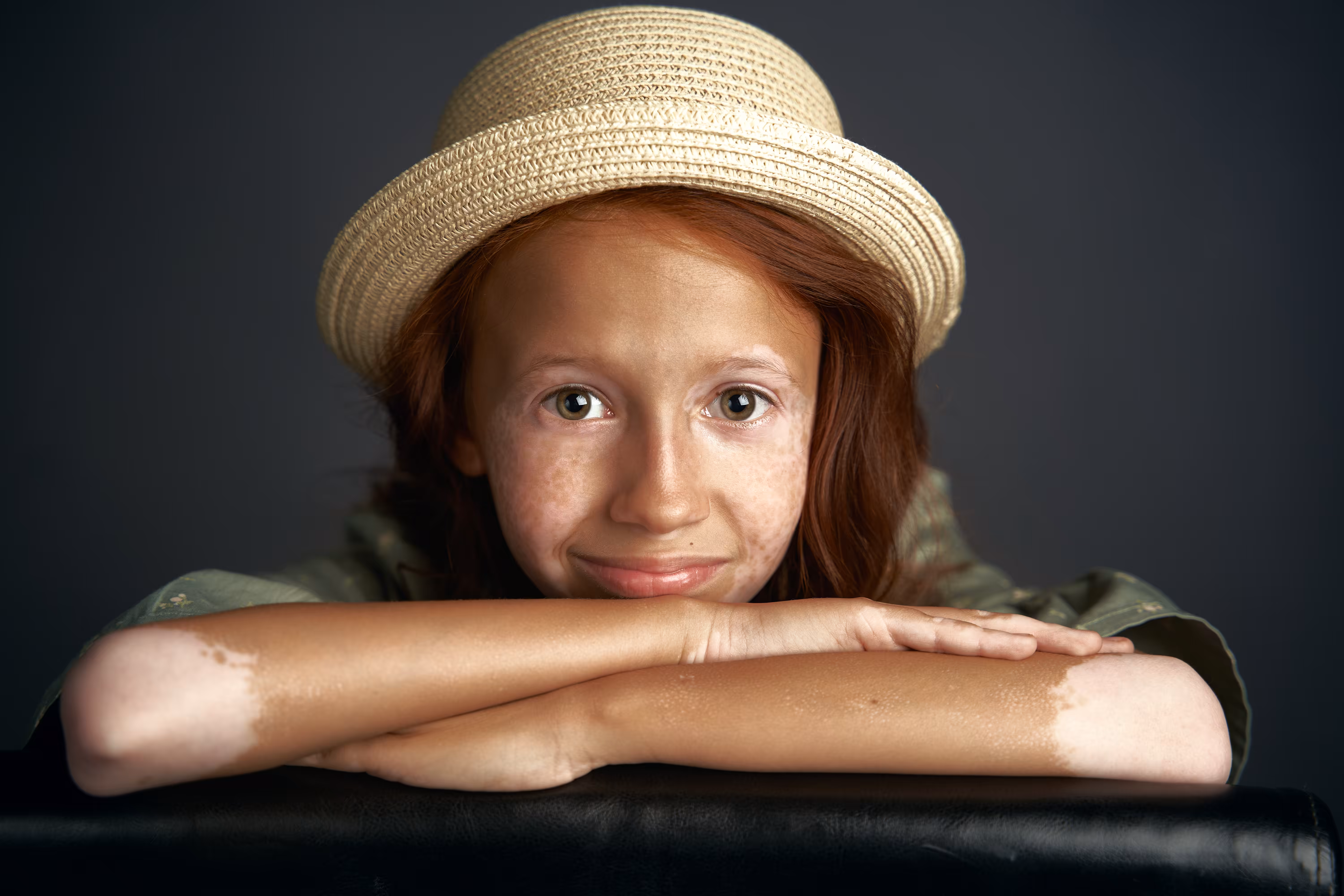 Vitiligo Girl