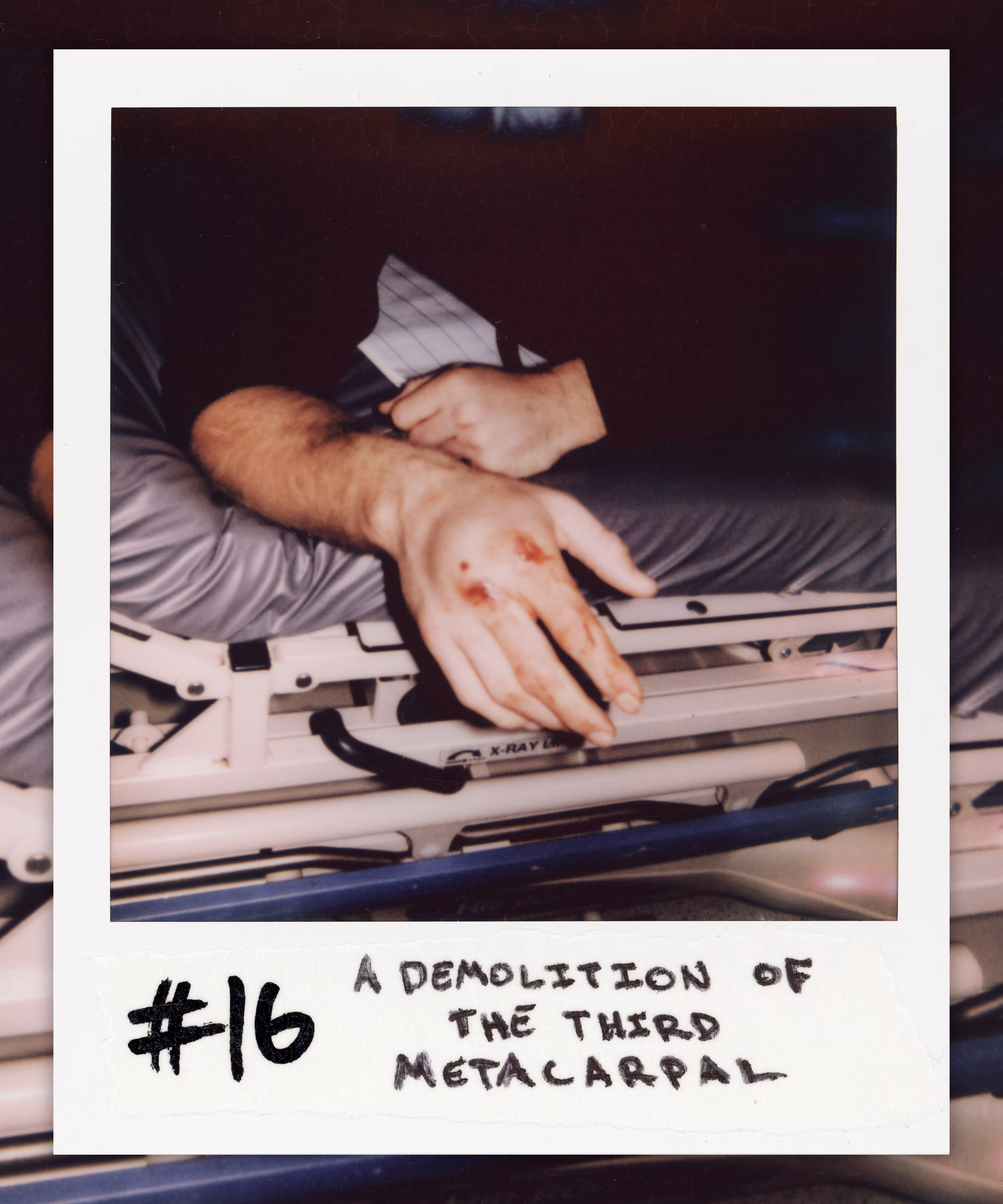 #16 A DEMOLITION OF THE THIRD METACARPAL