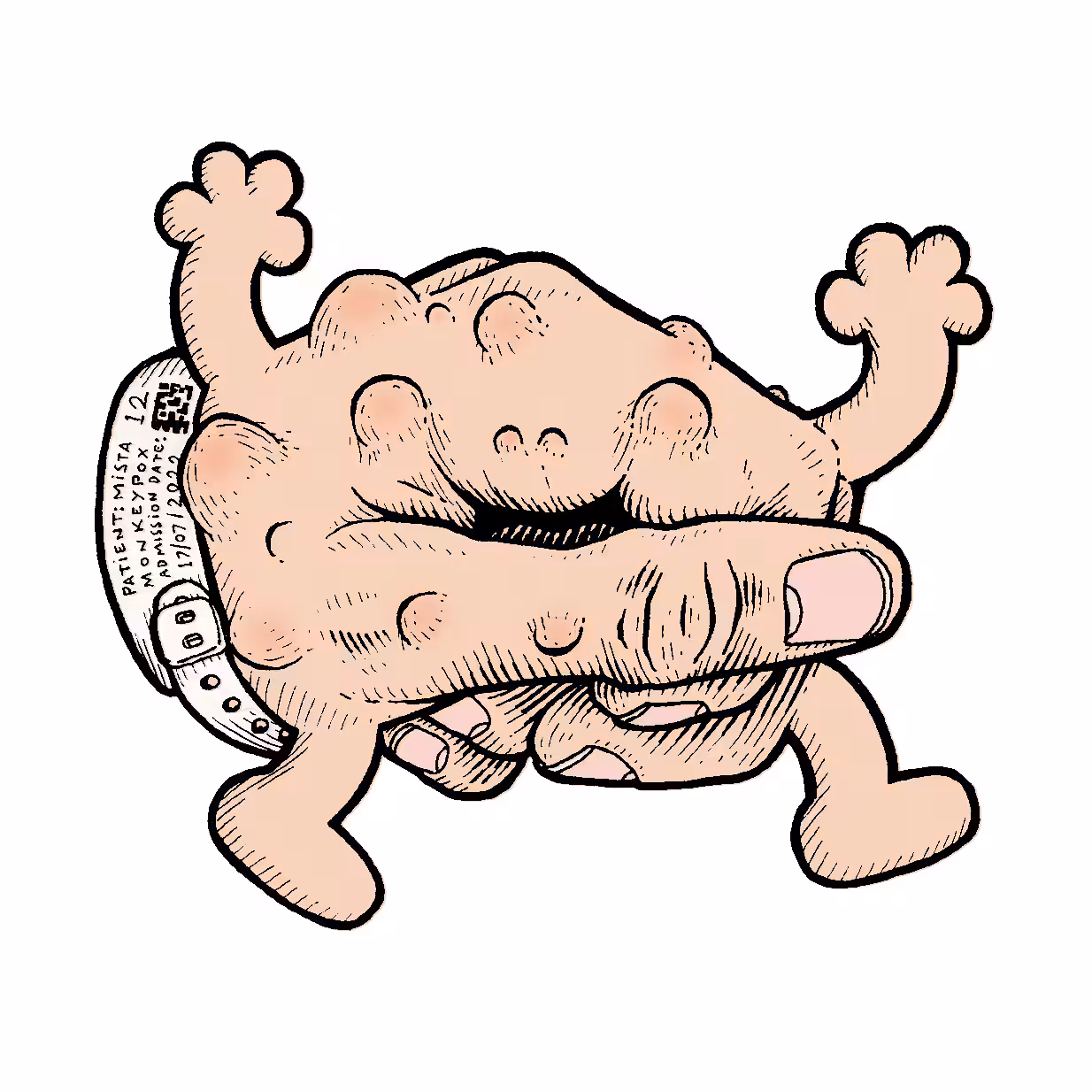 Mista Monkeypox