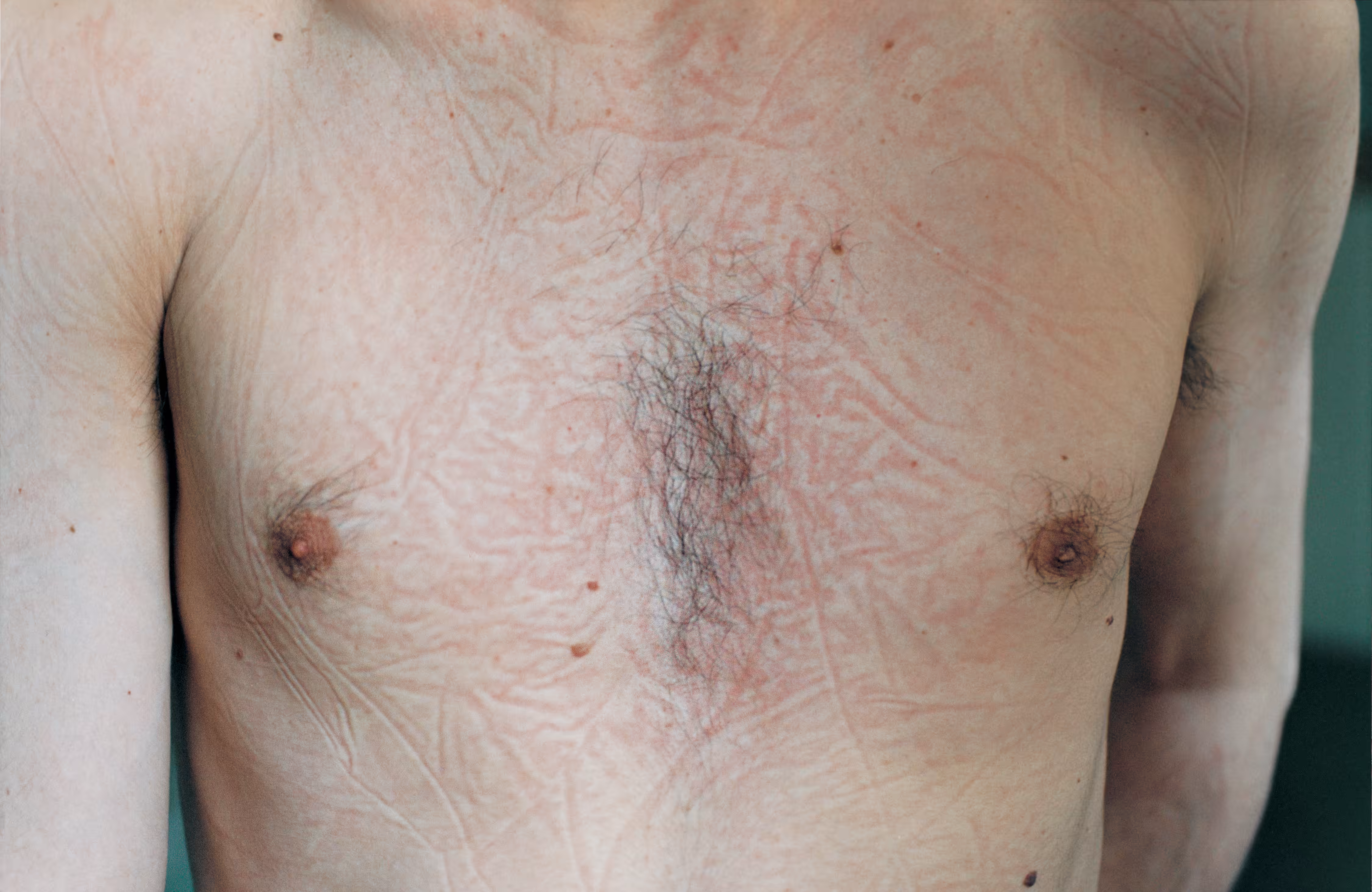 Closer - Sleep marks on chest, 1999