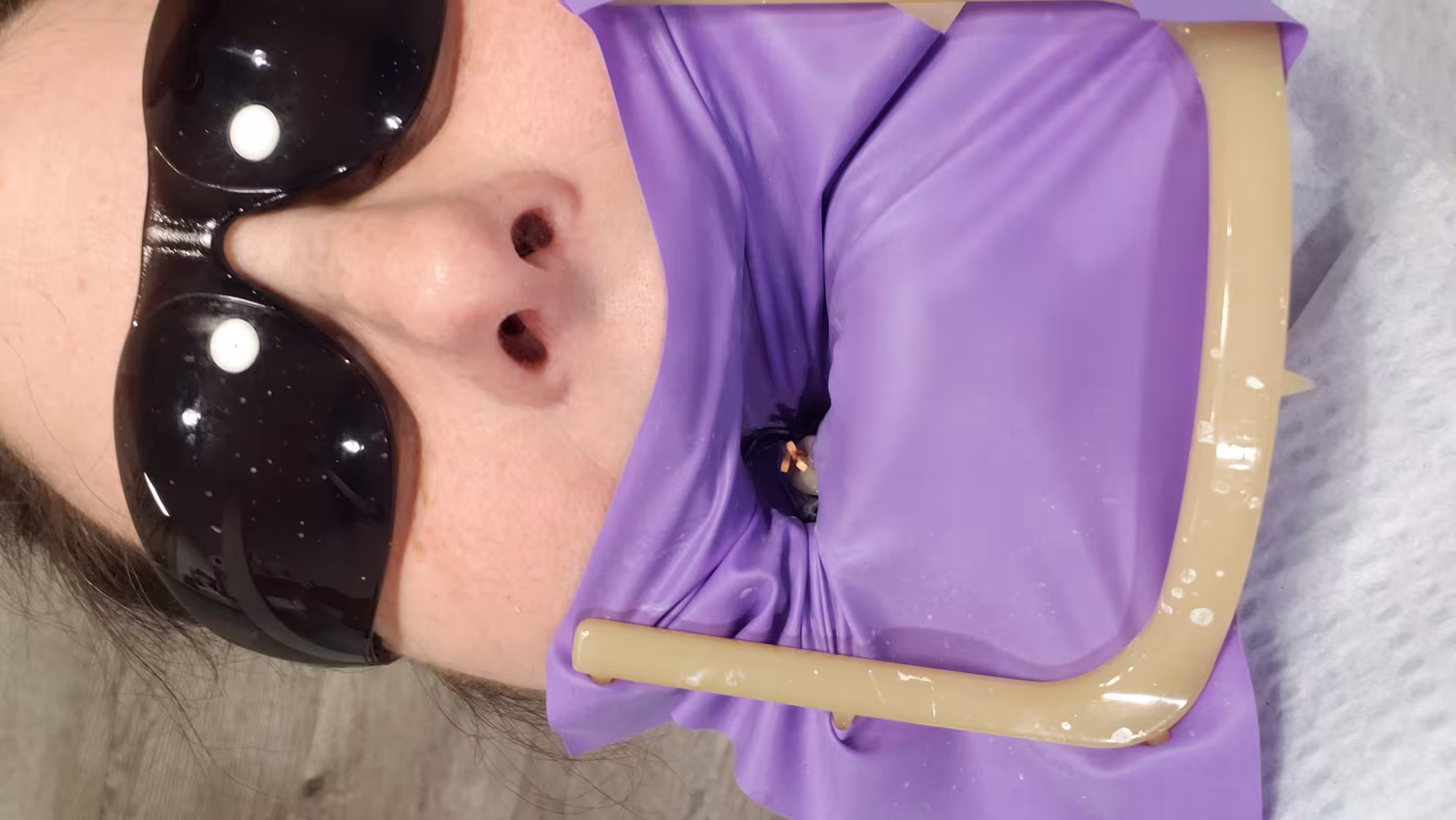 Root Canal