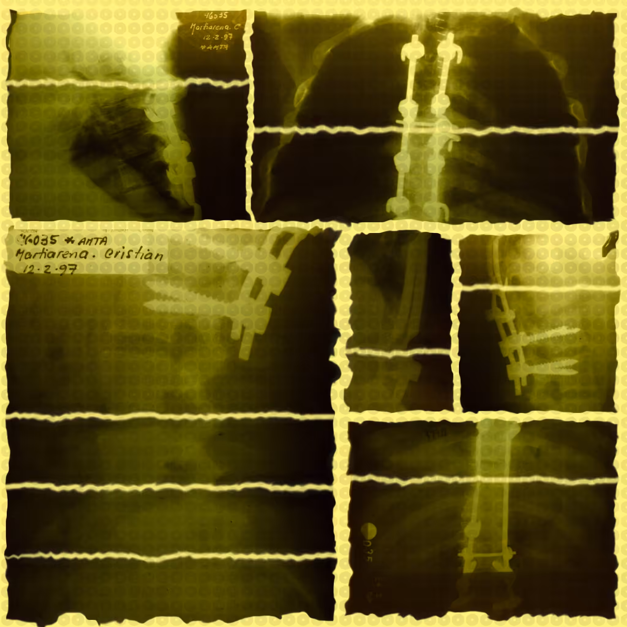 Cifoescoliosis