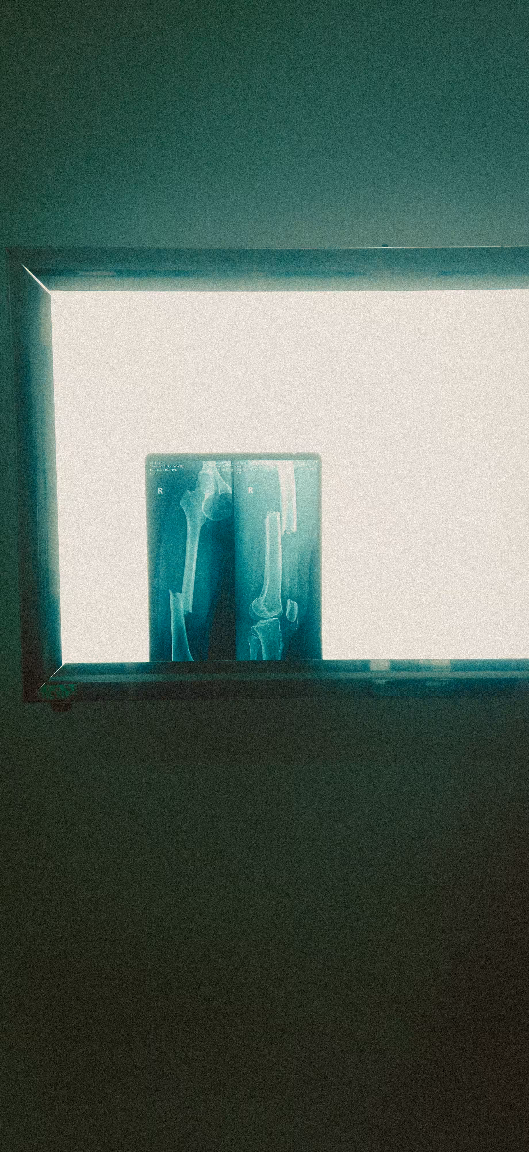 Broken Bones