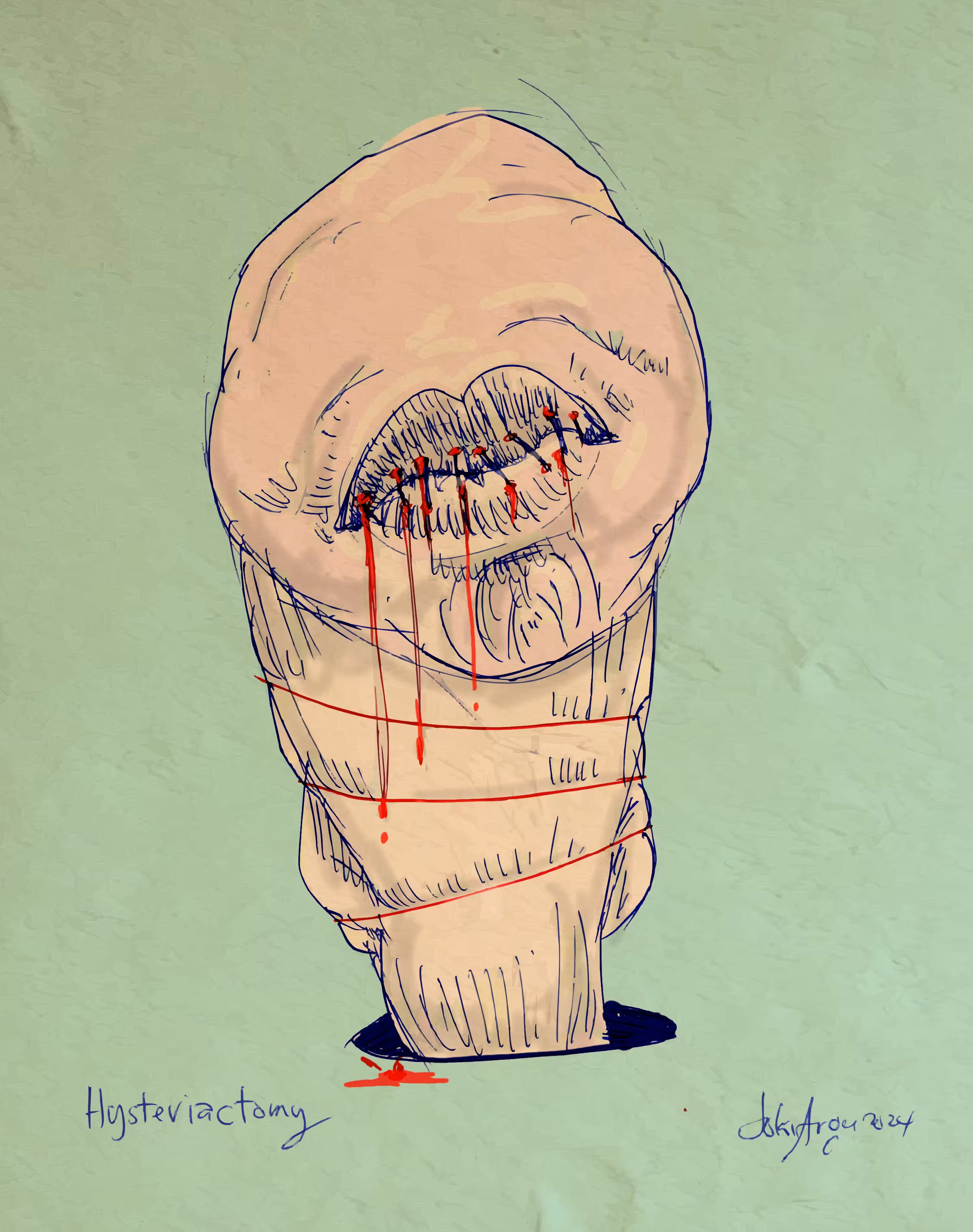 hysteriactomy