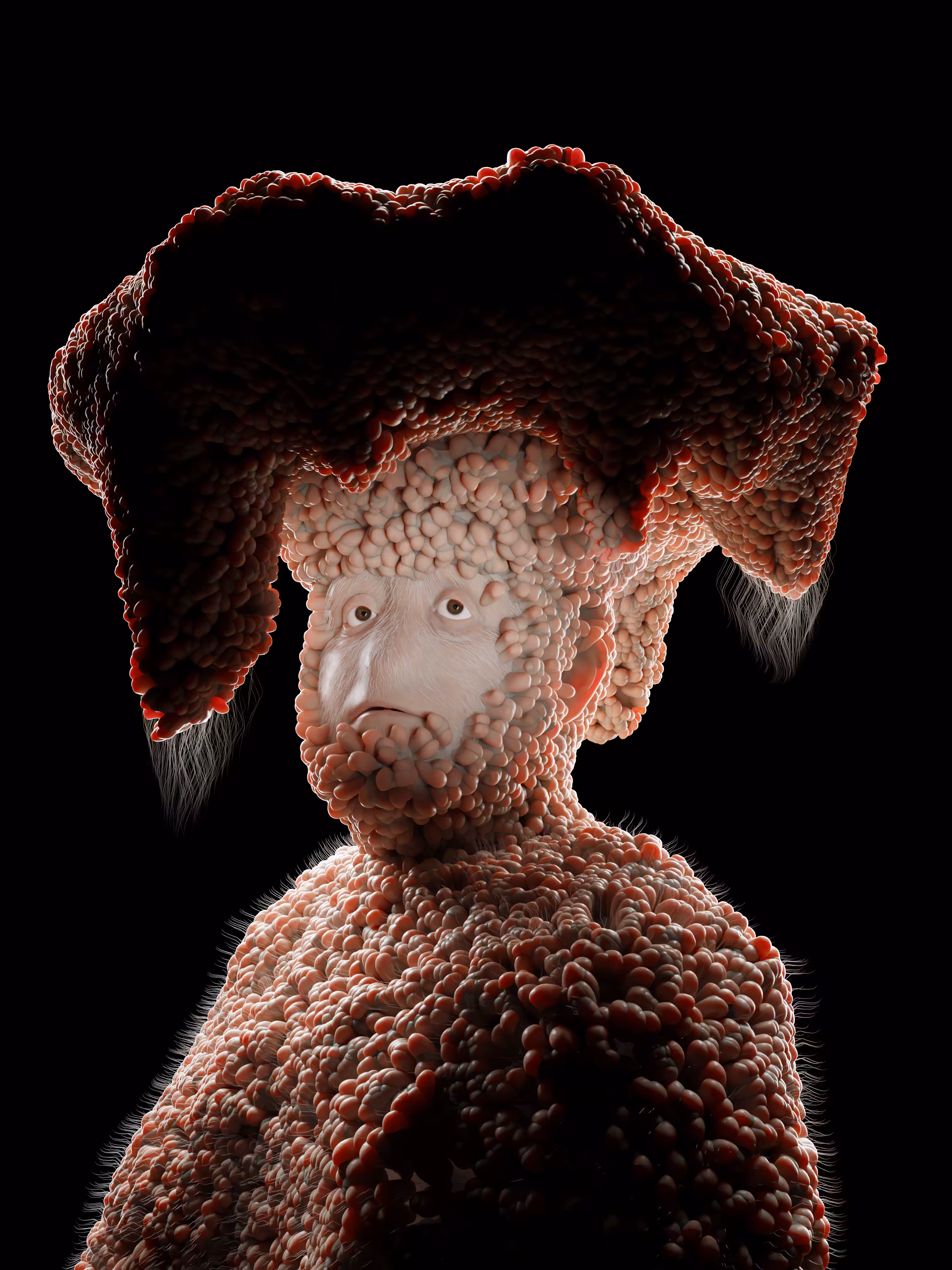 Neurofibromatosis.