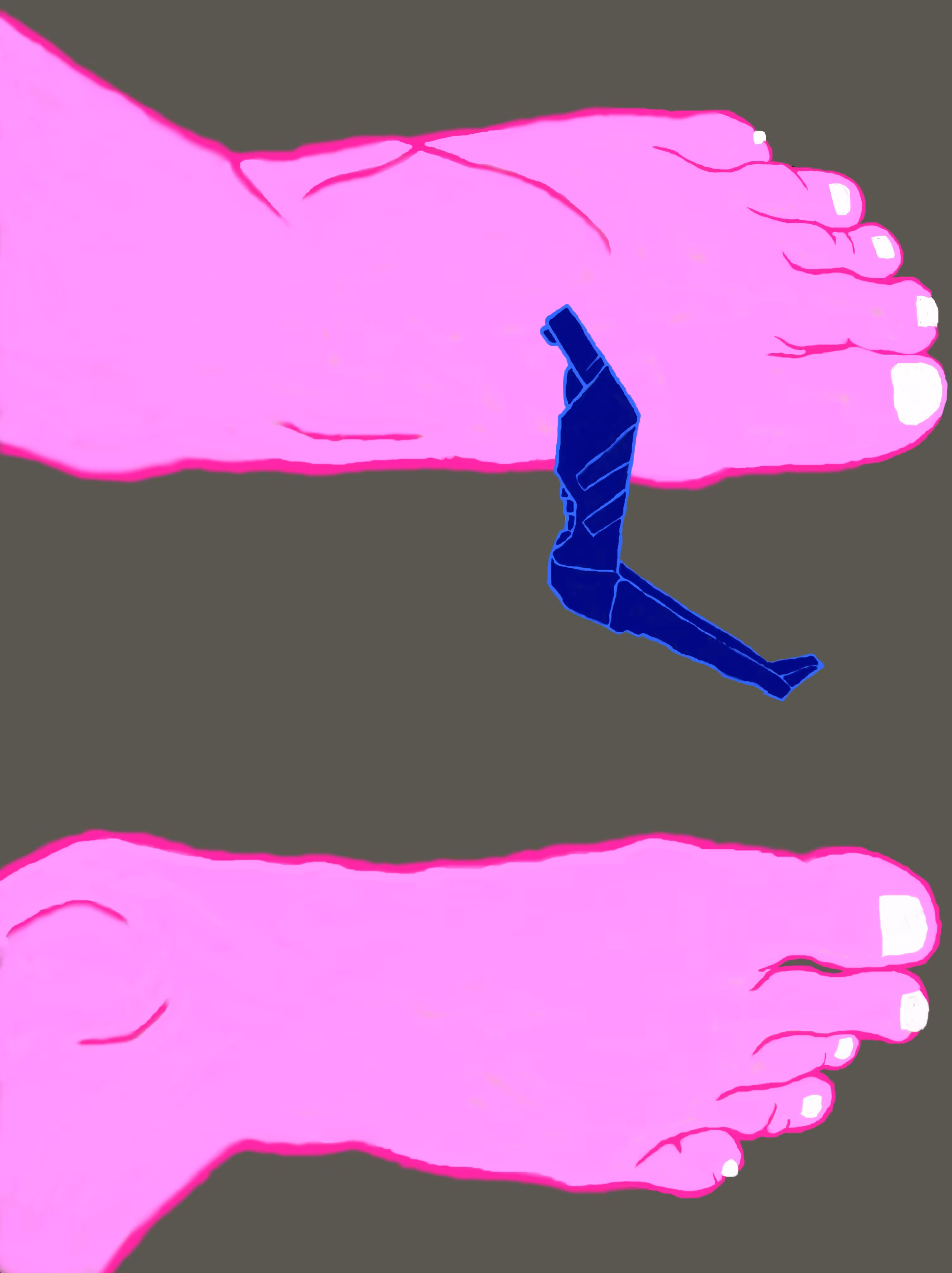 SWOLLEN foot with object
