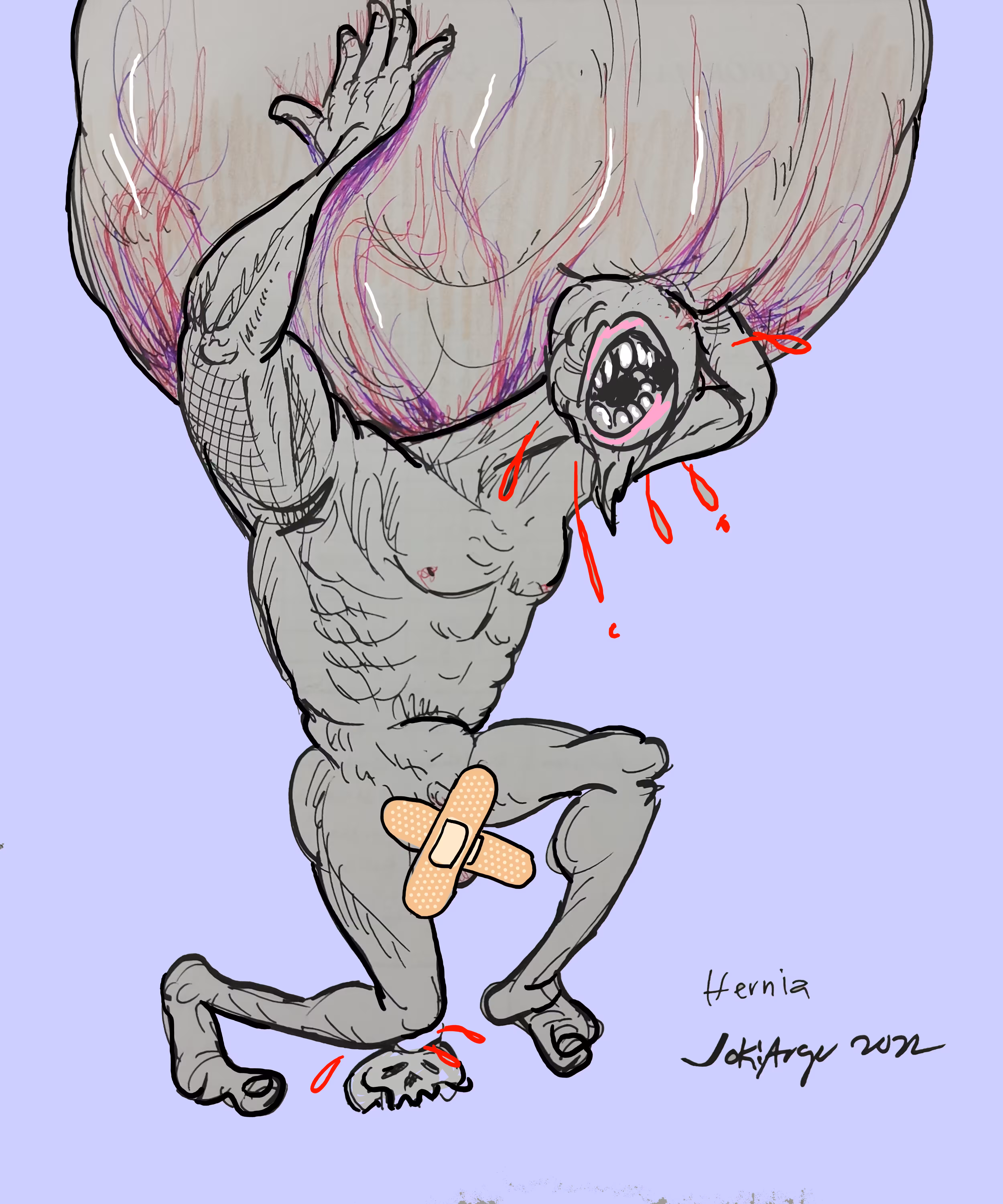 Hernia