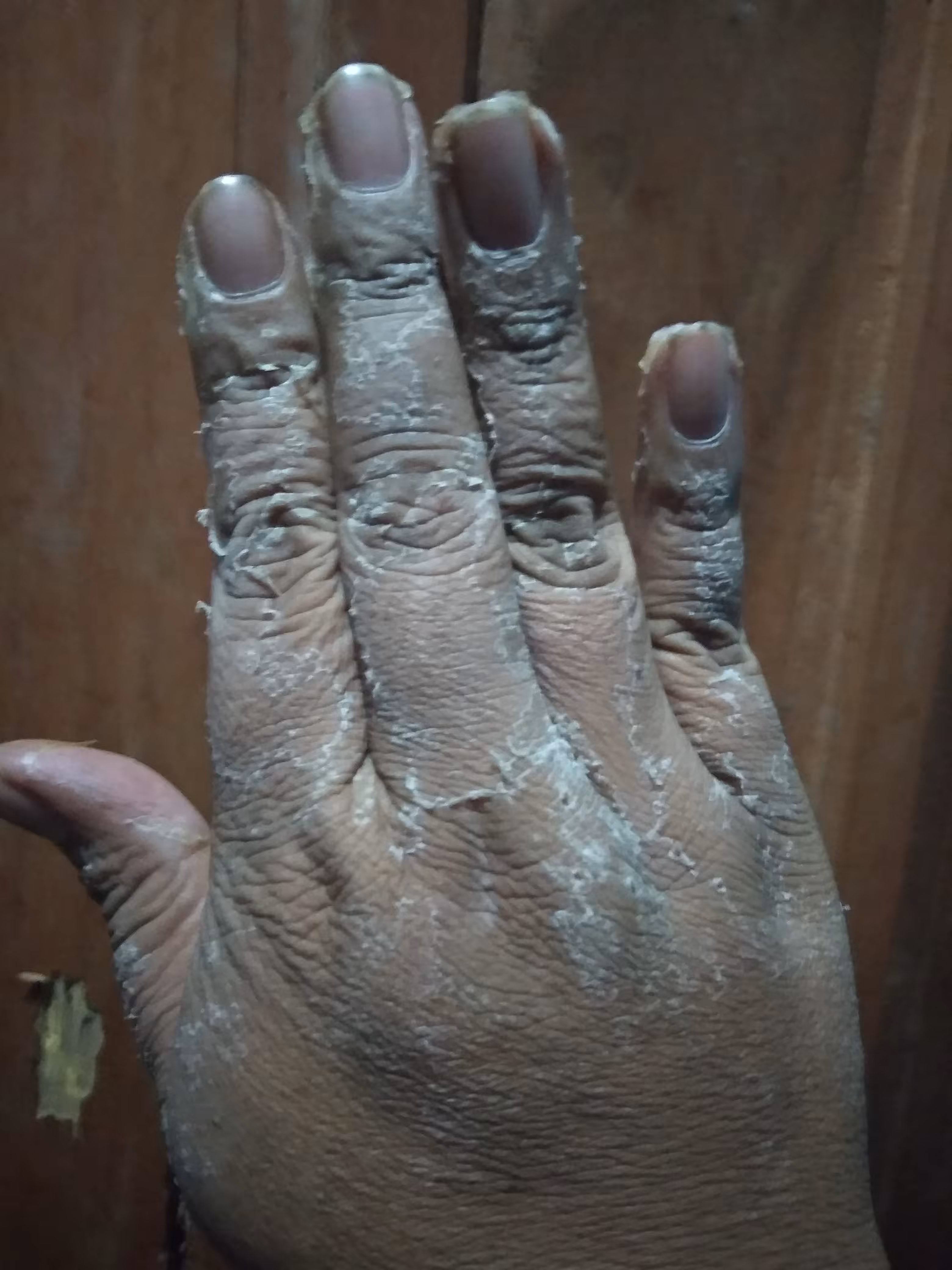 sick hand