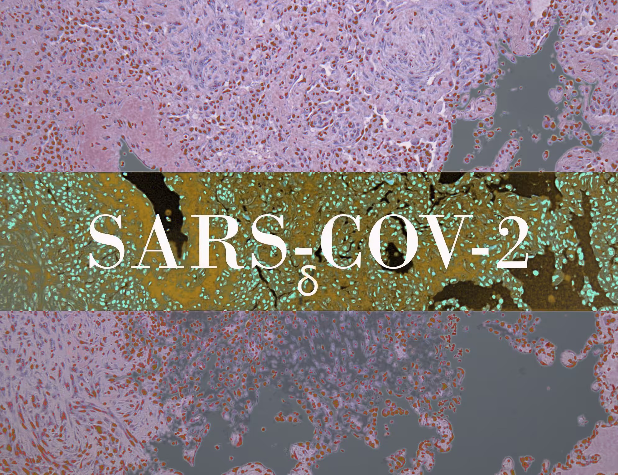 SARS-CoV-2δ-2