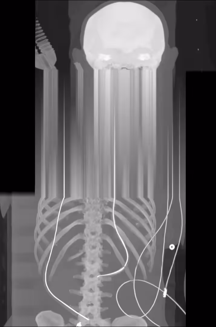 Anonymized_CT_scan_02