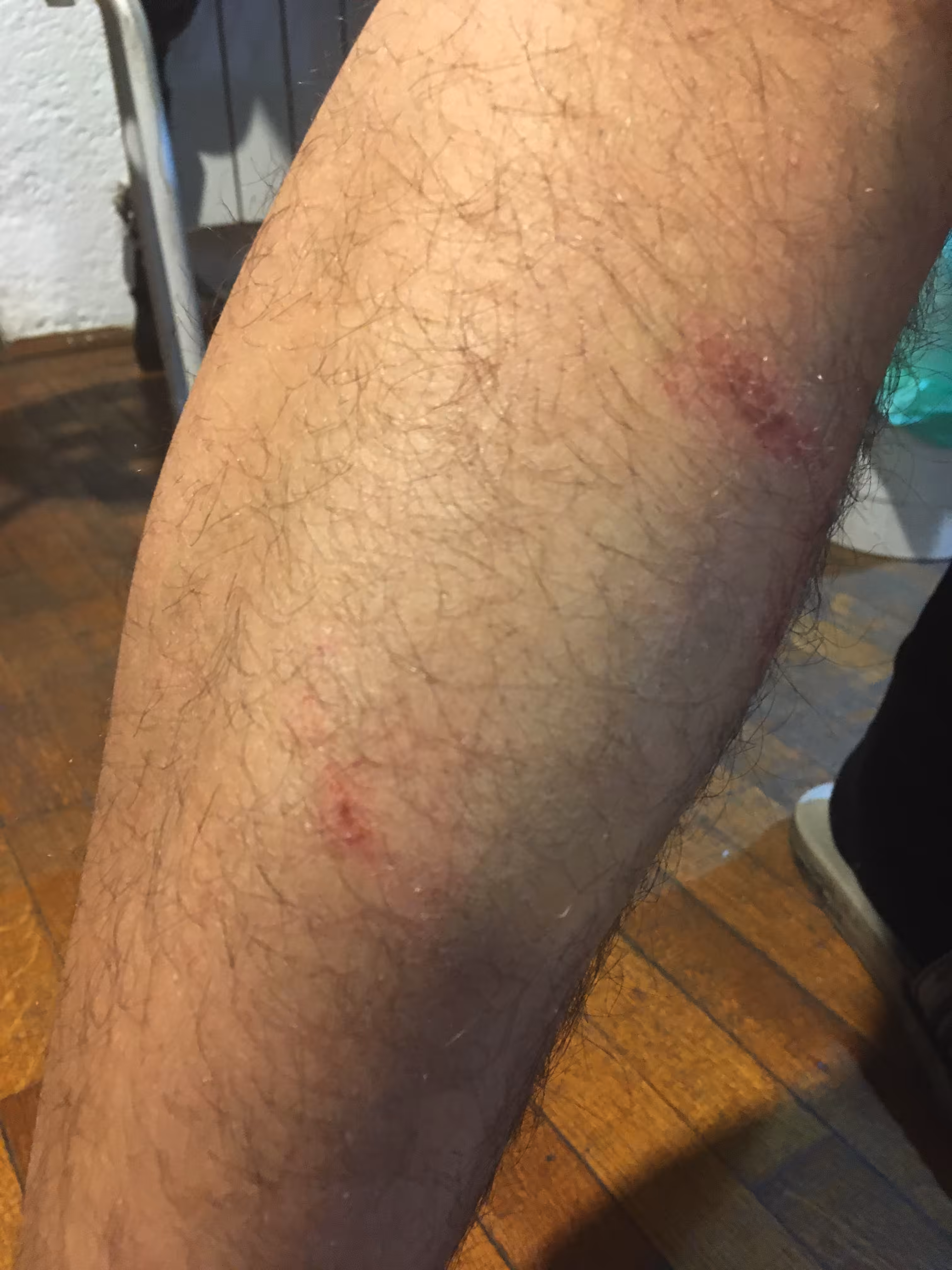 Bruise #3