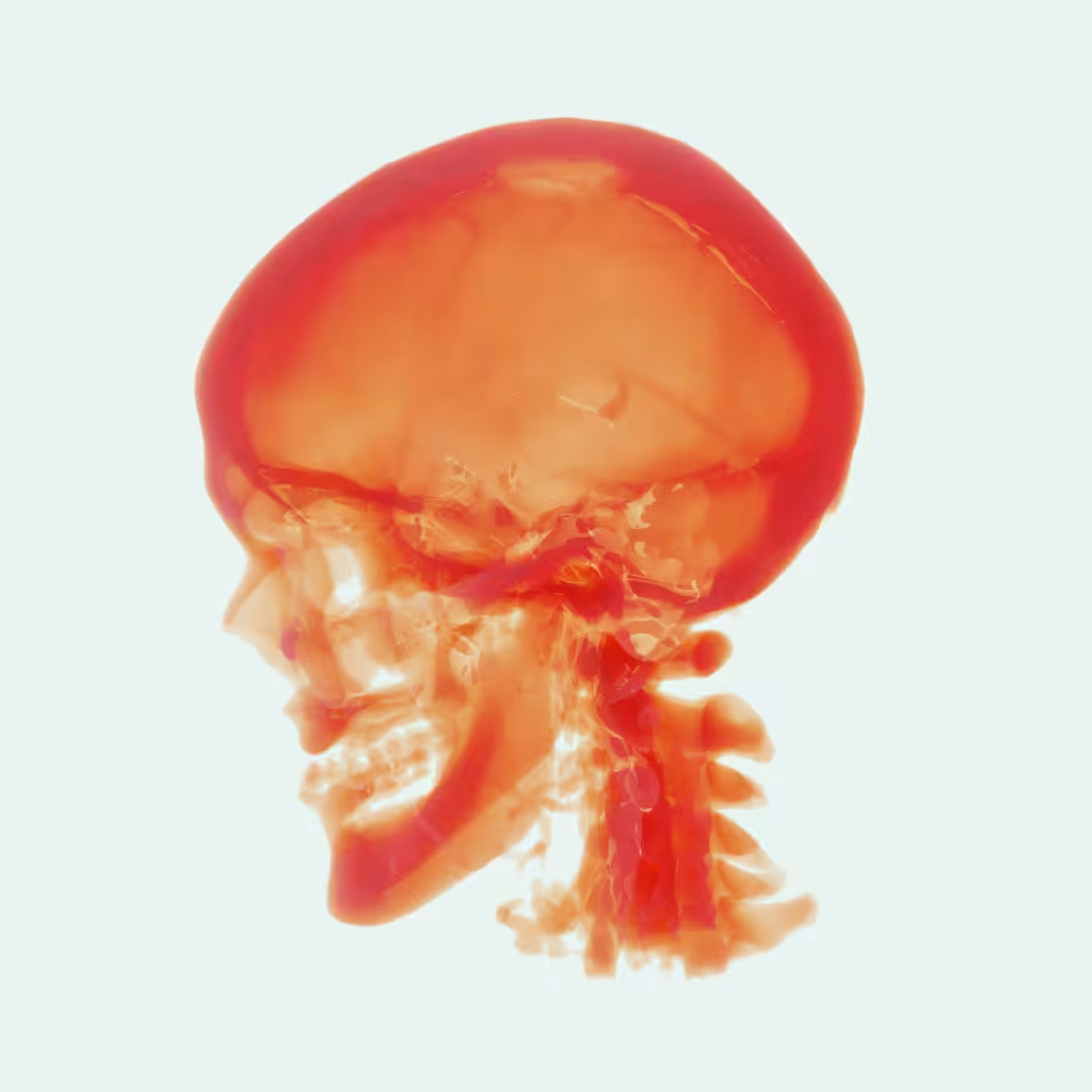 Migraine
