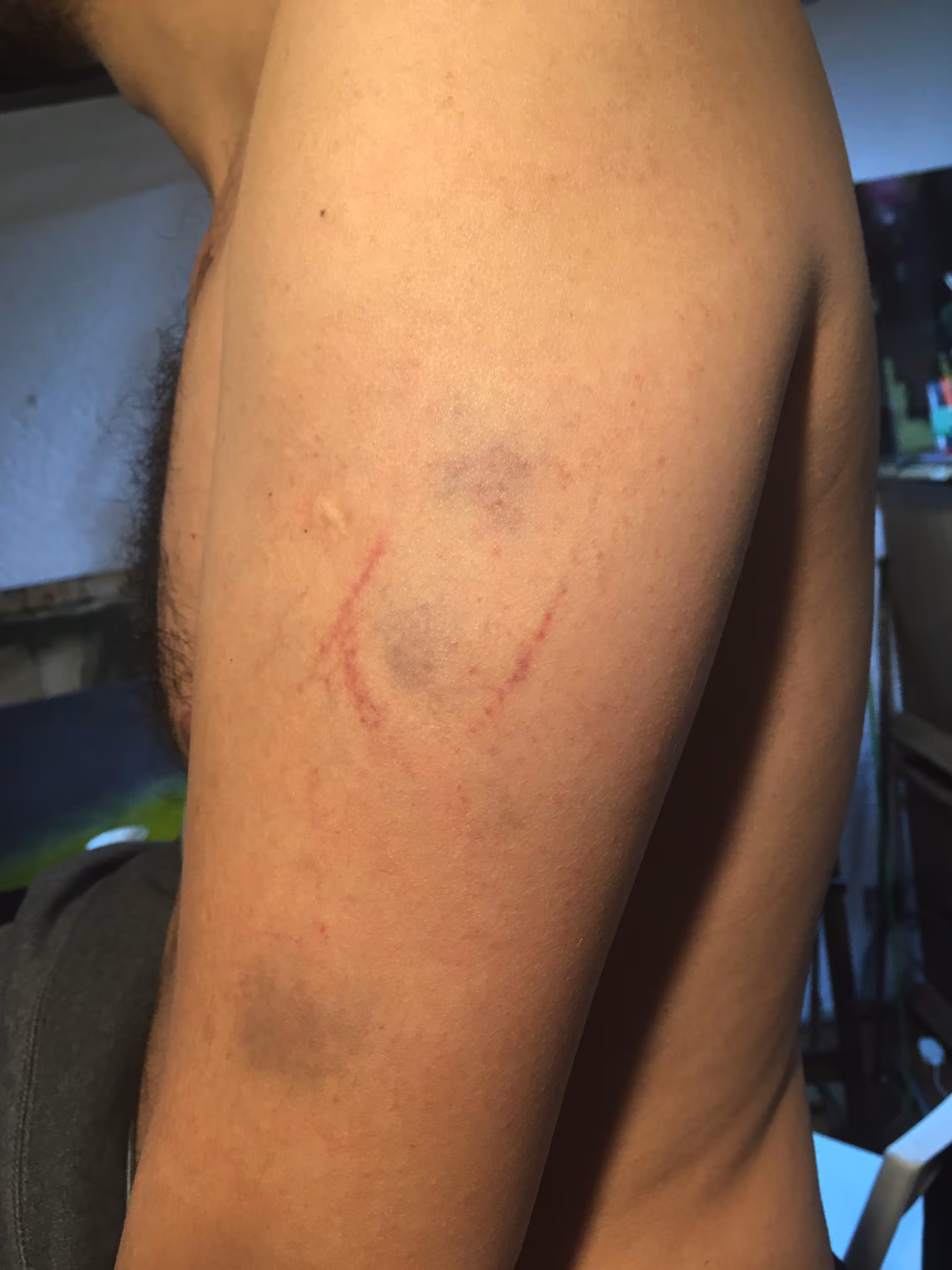 Bruise #1