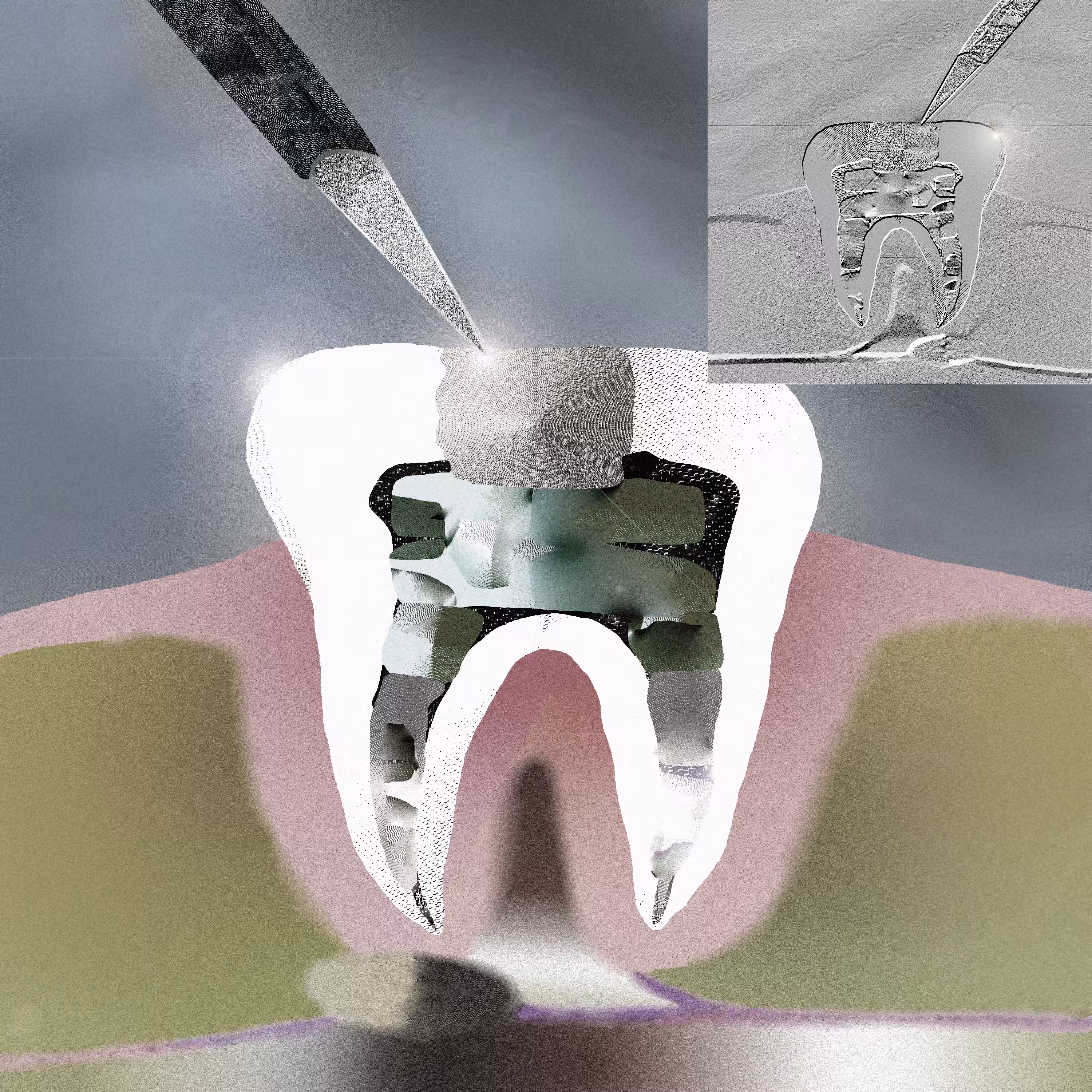 Pieza dental 23